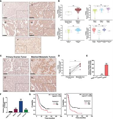 PFKFB3 Regulates Chemoresistance, Metastasis and Stemness via IAP Proteins and the NF-κB Signaling Pathway in Ovarian Cancer